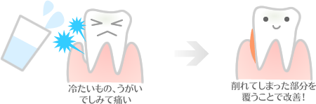 冷たいもの、うがいでしみて痛い場合は削れてしまった部分を覆うことで改善!