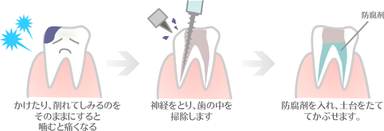(1)かけたり、削れてしみるのをそのままにすると噛むと痛くなる。(2)神経をとり、歯の中を掃除します(3)防腐剤をいれ、土台をたててかぶせます。